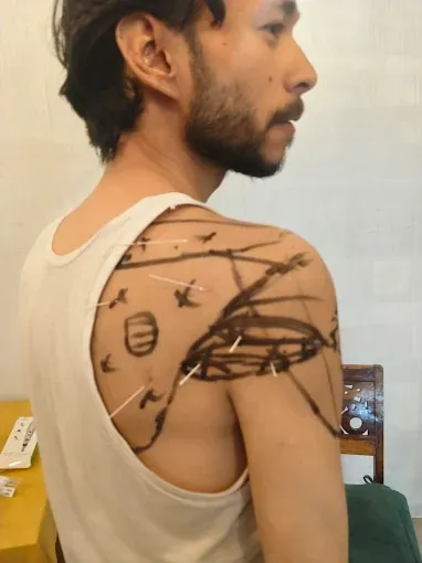 Dry needling points marked on a patient's shoulder